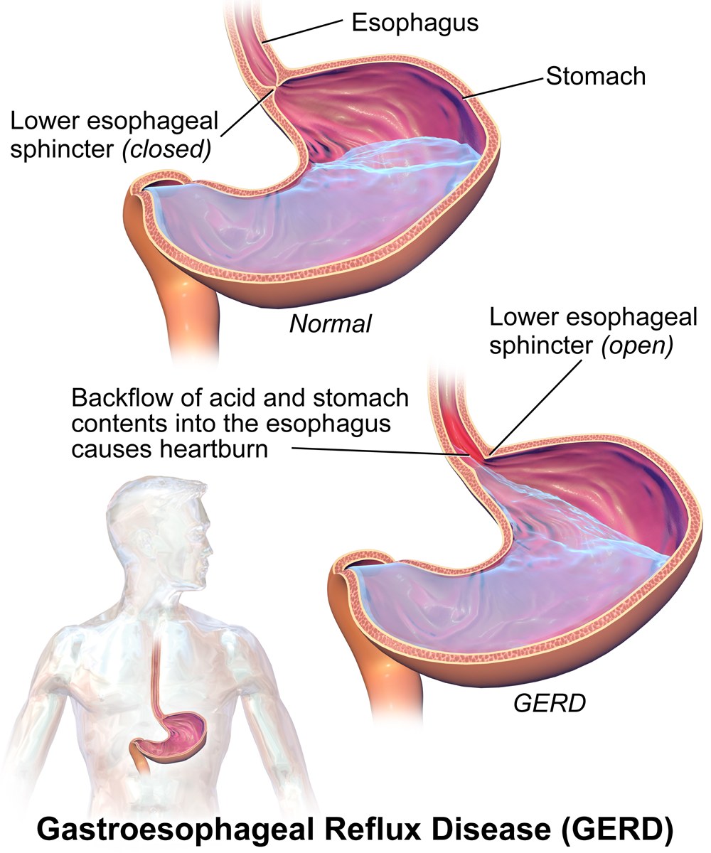 Medical illustration of a normal stomach with the lower oesophageal sphincter closed, beside a stomach with GERD where the sphincter is open and acid flows back up into the oesophagus.